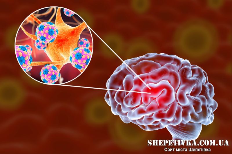 Енцефаліт та важкі пневмонії: у Шепетівці зафіксовано випадки важких ускладнень грипу