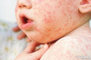 Через спалах кору на Хмельниччині скликали «надзвичайну комісію»