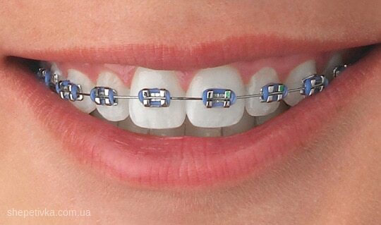 braces image 2