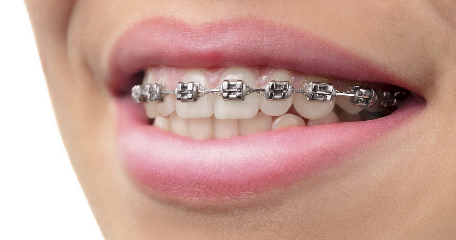 ціна металевих брекетів