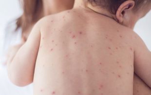 На Хмельниччині зростає захворюваність на вітряну віспу