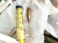 Хмельницькі нейрохірурги витягнули кулю з хребта 27-річного військового