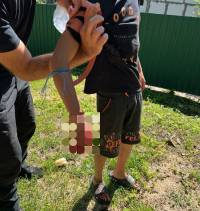 Підліток лишився без пальців через підібрану на вулиці вибухівку